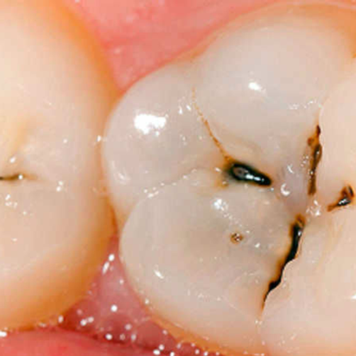 Dental stains and it’s management